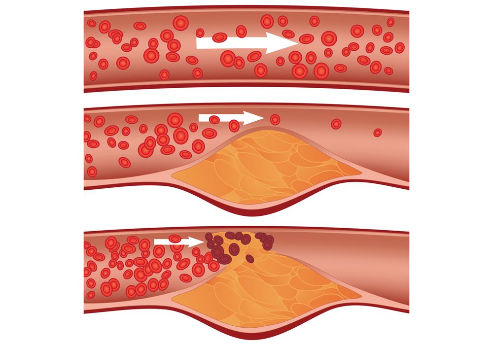 How To Lower Your Cholesterol Levels | Health and Wellbeing Check