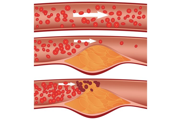 How To Lower Your Cholesterol Levels | Health and Wellbeing Check